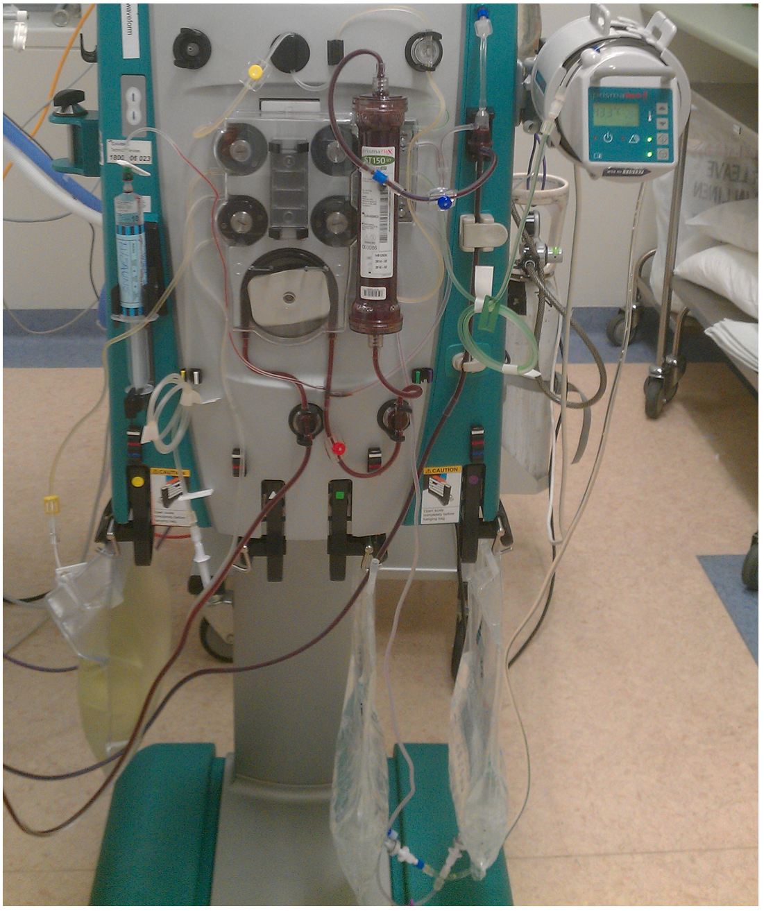 Anatomy of the extracorporeal dialysis circuit Deranged Physiology